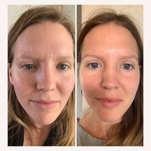 Collagen Before and After Photos with Incredible Results